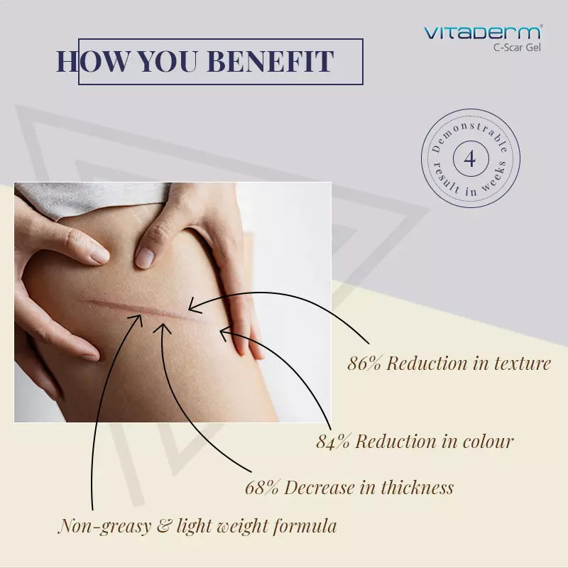 vitaderm s scar gel benefits