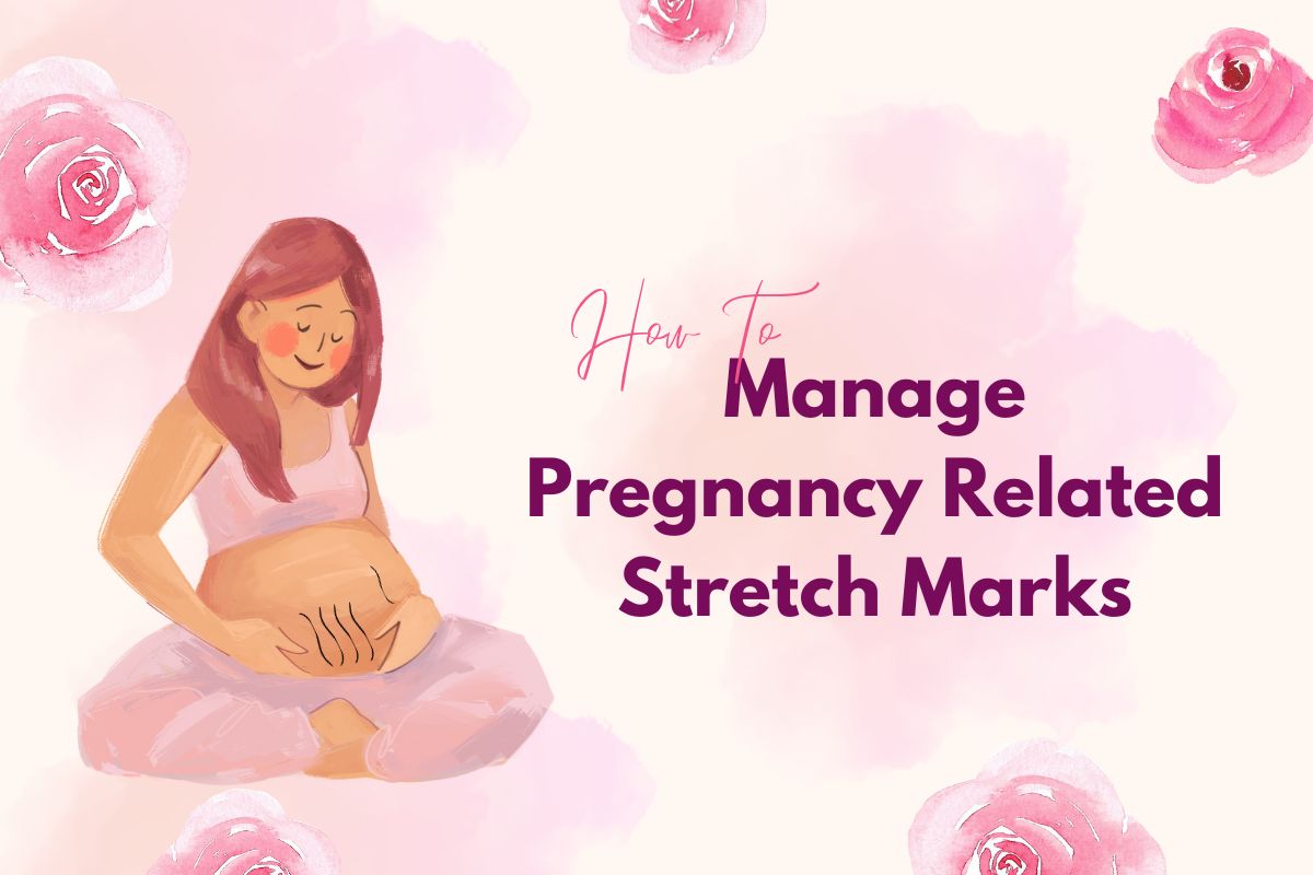 How to prevent and manage pregnancy-related stretch marks easily