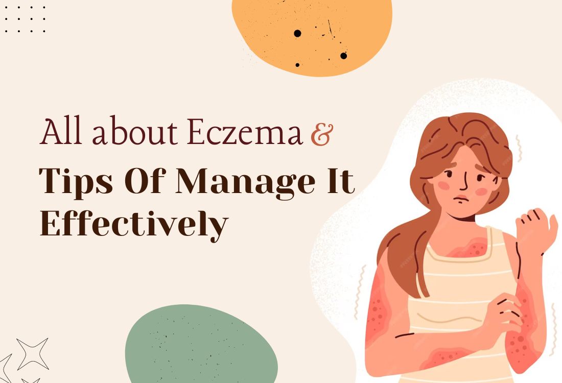 All about Eczema and tips to manage it effectively