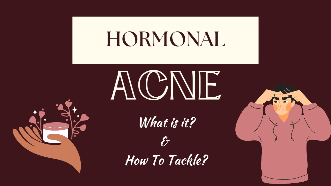 Hormonal Acne: Types, Causes, Diet & Treatment