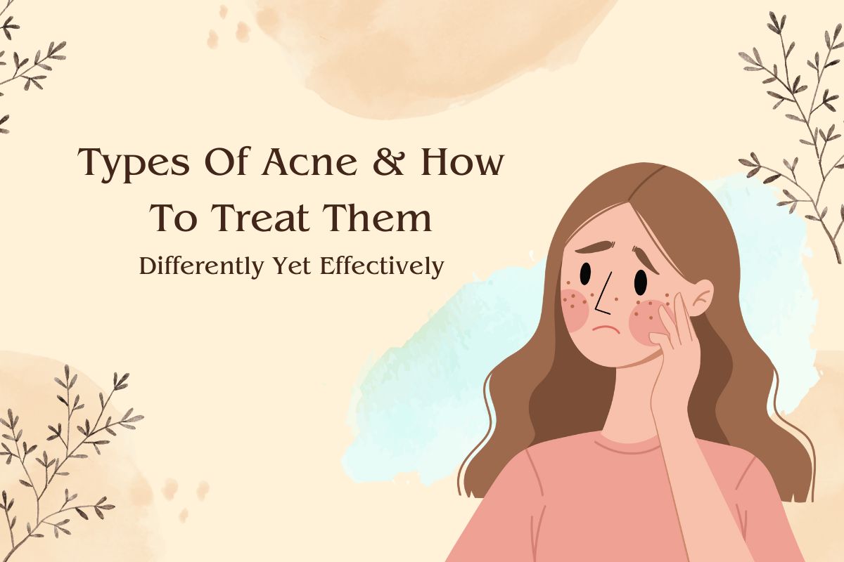 types of acne and how to treat them